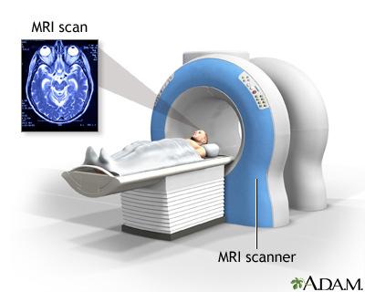 Some MRI exams require a special dye, called contrast material. The dye is usually given before the test through a vein (IV) in your hand or forearm.