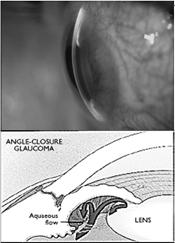 Angle Closure Glaucoma Subconjunctival Hemorrhage