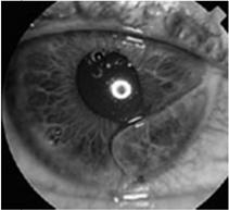 Surgical treatment Hyphema Ruptured Globe Severe eye