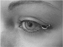 anti-vegf injections Disorders of the Eyelid and Orbit Ptosis