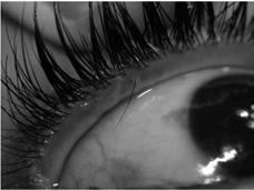 Trichiasis Ectropion/Entropion Eyelash growing inward toward the