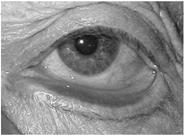 Entropion: rotation of eyelid inward Irritation of the ocular