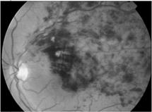 Retinal Vein Occlusion Neuro-Ophthalmology