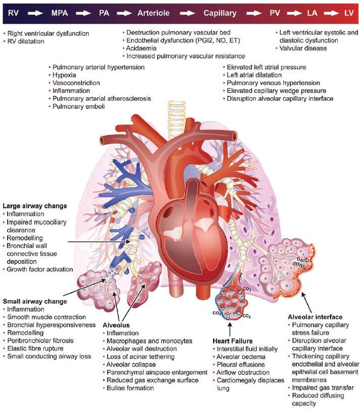 CARDIOPULMONARY PATHOPHYSIOLOGY AND INTERACTIONS IN PATIENTS WITH HEART