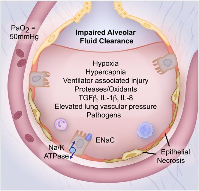 pathways Impaired alveolar fluid clearance Am J