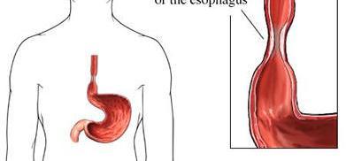HIGH OBSTRUCTION (ESOPHAGUS) Abdomen may be flat, and