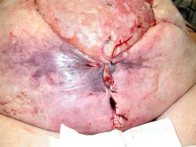 Difficult Infected Wound After Colorectal Surgery 117 Image 2. Deep incisional surgical site infection involving rectus sheath and preperitoneal space. Image 3.