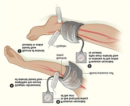 Ankle Brachial Index (ABI) Procedure The procedure for recording Ankle Brachial Index (ABI), also known as Ankle Brachial Pressure Index (ABPI) or Resting Pressure Index (RPI), is as follows.