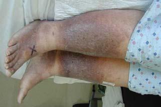 Clinical Features A number of clinical signs are associated with chronic venous insufficiency (CVI) and useful in making a differential