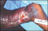 Hemosiderin Staining/Hyperpigmentation Chronic venous insufficiency (CVI) leads to distension of the blood capillaries and damage to the