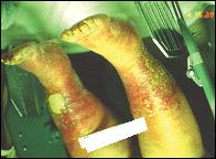 Clinical Features (Continued) Venous Dermatitis and Eczematous Changes Venous dermatitis and eczematous changes are
