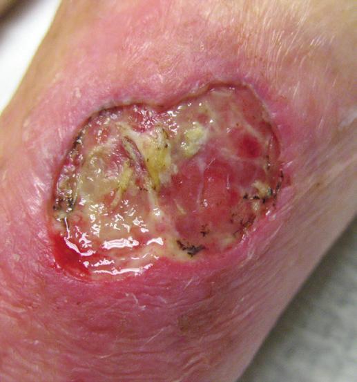 A B C Figure 3. Case 2: Venous leg ulcer (VLU) progression of wound to closure. (A) Left VLU at presentation (5.4 cm x 5.7 cm x 0.