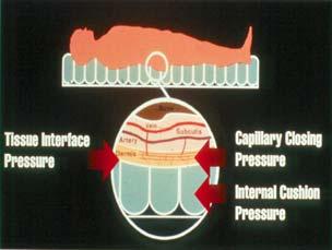 Pressure Ulcer Pressure Ulcer Soft tissue is compressed. Circulation becomes impaired, depriving the tissue of oxygen and nutrients which results in tissue death.