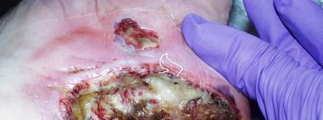 Based on Wound Appearance Necrotic Infected Guides Treatment & Management Appearance Generally guides the wound care