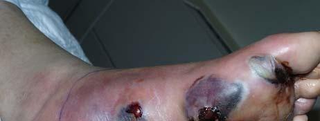 Infected Wounds Studies show that wounds with more than 100,000