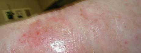 accompanied by local or systemic symptoms Induration, Fever, Edema,