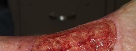 bioburden/biofilm Draining Wounds Wounds with excessive drainage