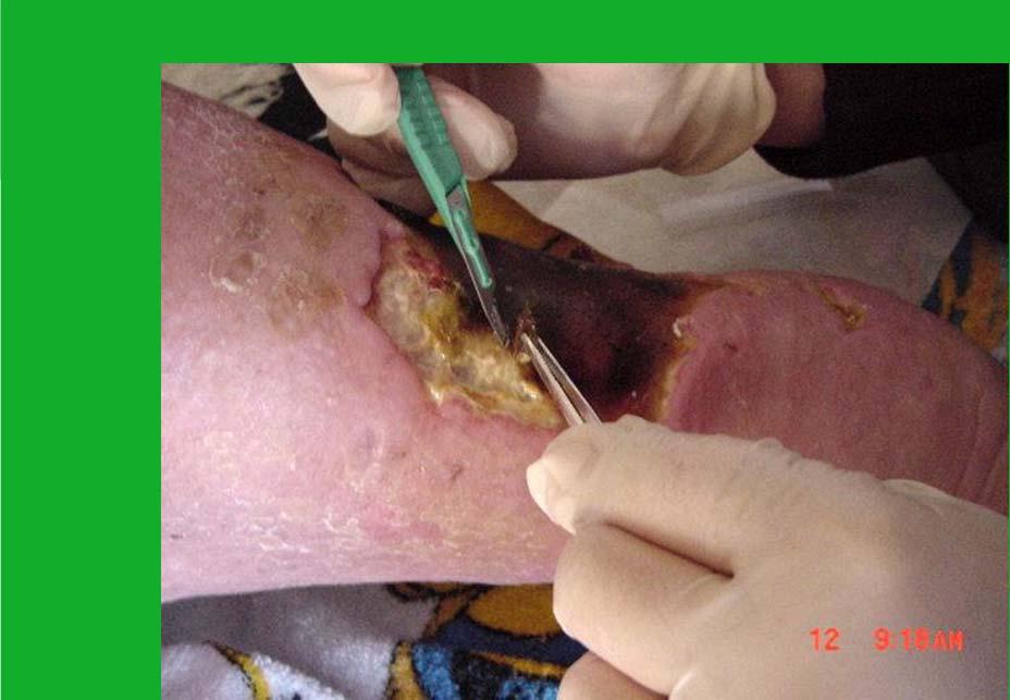 Sharp debridement of non-viable tissue