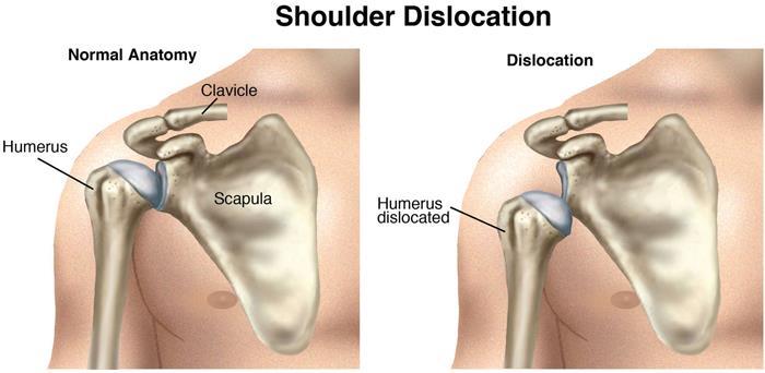 If you have any questions and concerns, please speak to the doctor or nurse caring for you. What is an arthroscopic shoulder stabilisation?