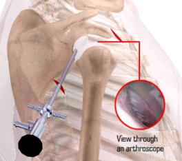 Arthroscopy - Introduction Shoulder Arthroscopy The television camera attached to the arthroscope displays the image of the joint on a television screen, allowing the surgeon to look, throughout the