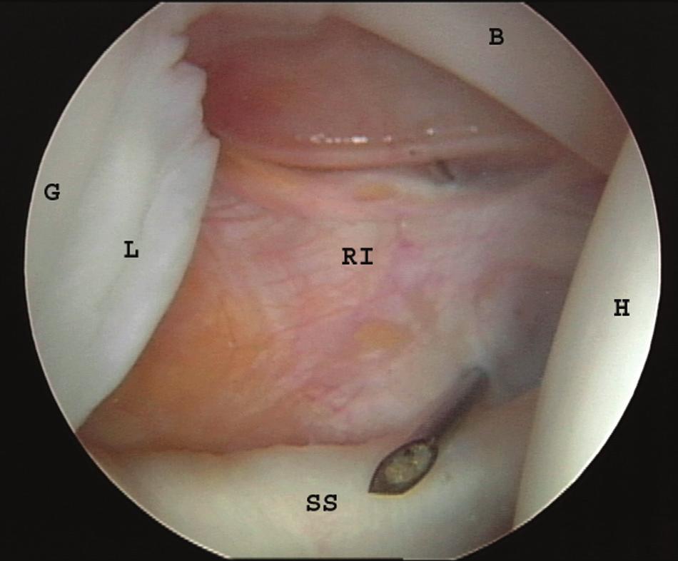 Arthroscopic Rotator Interval Closure 137 applied to the suture to draw the superior glenohumeral ligament and the inferior rotator interval tissue together, thus demonstrating the degree of rotator