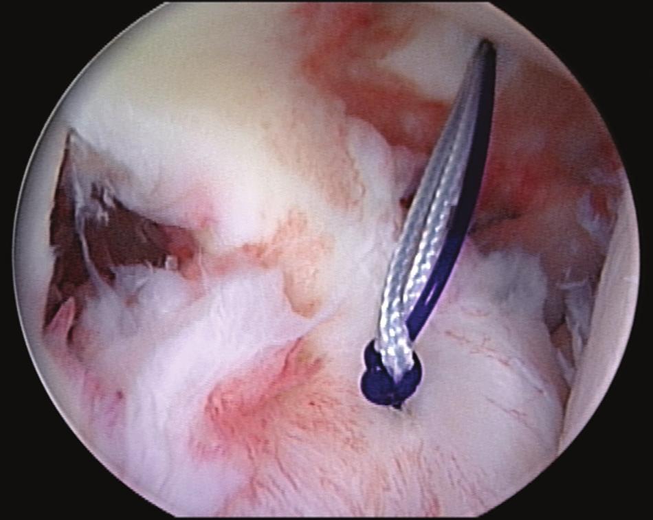 glenohumeral ligament and capsule.