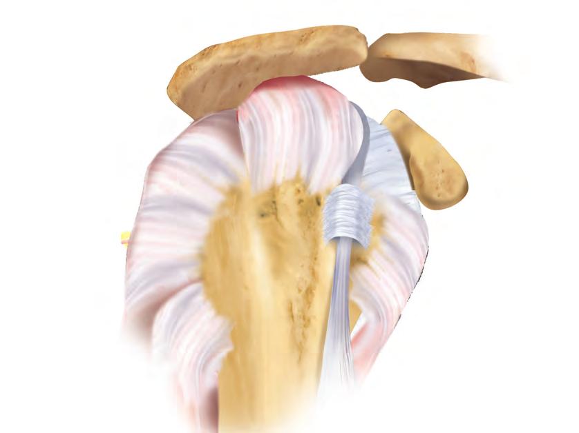 Healthy Shoulder - Side View Rotator Cuff Tear Age plays an important role in the development of rotator cuff tears.