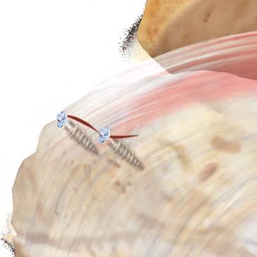 of the shoulder), and to smooth the edges of the cuff tear.