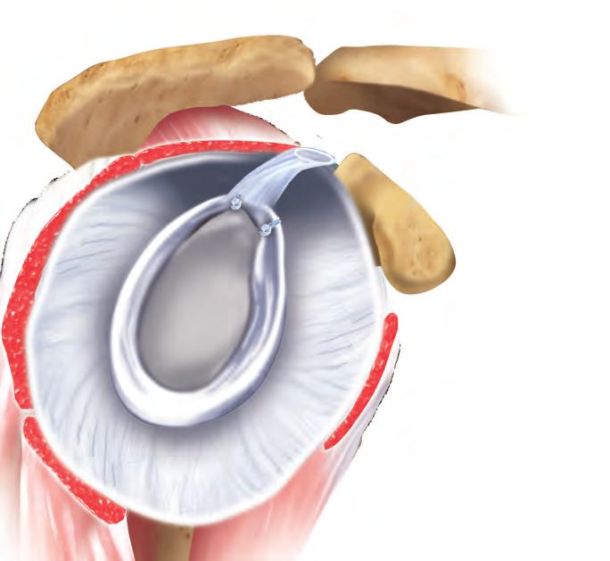 Instability Repair For years, shoulder instability has been treated with open surgery to repair the torn lip of the glenoid socket, called the labrum.