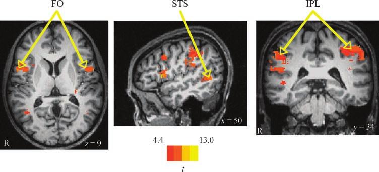 Figure 2. Significant activity in the MNS during imitation of facial expressions and social hand gestures as compared to baseline activity.