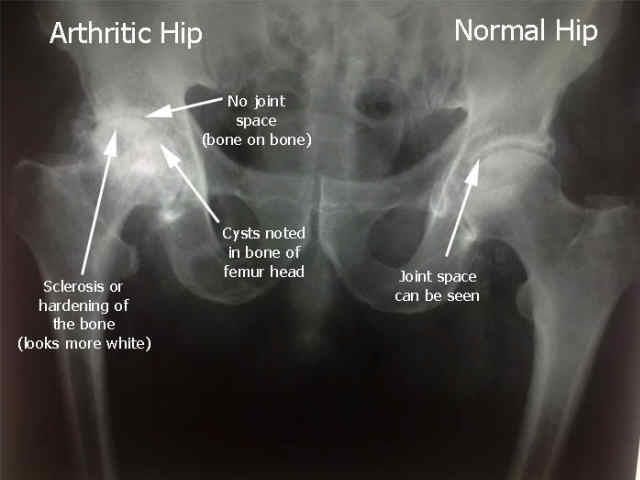 X-Ray of Hip with