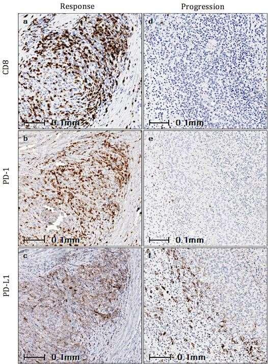 PD-1 blockade induces responses by inhibiting adaptive immune resistance CD8 PD-1 PD-L1 Response Progression Melanoma cell or tumor macrophage Melanoma cell or tumor