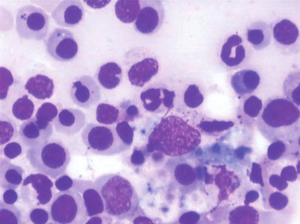 Table 4: Parameters of HLH according to proposed HLH diagnostic criteria, 2009 [6] Figure 1: Bone marrow aspirate smear with features of showing neutrophil engulfed by macrophage ( 400, Jenner