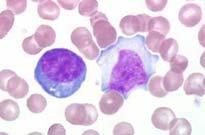 Atypical leukocyte Today: Blood Slides Normal Wright Stain RBCs WBCs: neutophil, lymphocyte, monocyte RBC diameter WBC diameters Sickle cell anemia slide Erythroblastosis slide Today: Blood Slides