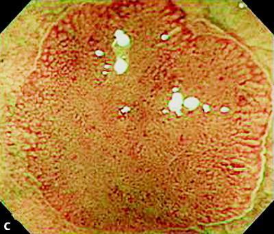 Rex; CGH 2010; 8: 318-21 Innovations in colonoscopy: Detecting more polyps Finding more polyps