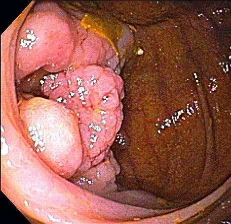 Minimizing Harms of Colonoscopy Not all polyps should be removed Assess likelihood of incomplete