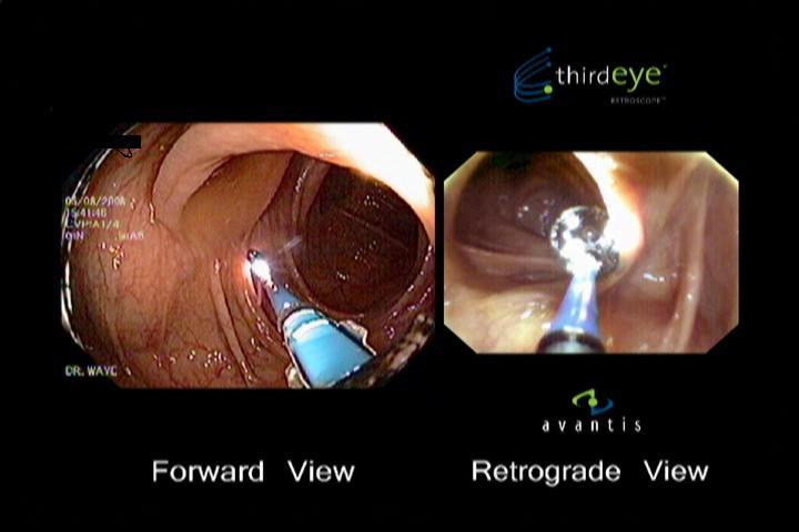 colonoscopy Omni-vision Cap-assisted Hewitt; DDW 2010 Transparent retractable