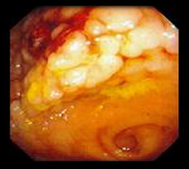 Villous Adenoma Malignancy rate is high 30 40% Typically appear as solitary, sessile and large May bleed easily Have a