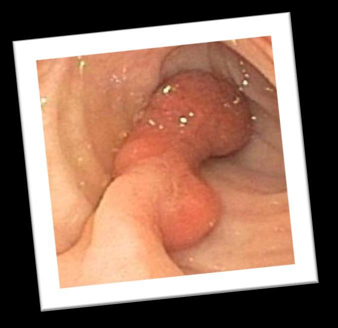 Tubulovillous Adenomas A combination of both tubular and villous tissue May be pedunculated or sessile Surface can be smooth or