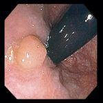 Non-neoplastic Polyps Hyperplastic Polyps Usually less than 5 mm in size diminutive polyps Commonly found in the rectosigmoid area Develop as a result of a