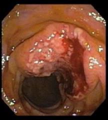Colorectal Cancer Ulcerated,
