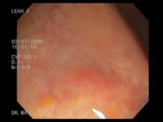 Diagnosis Flat tubular adenoma made