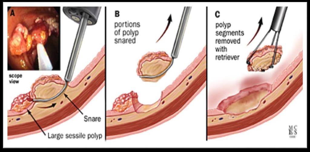 Polyp Resection Techniques Piecemeal polypectomy with