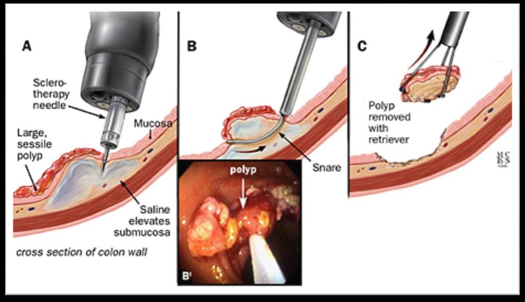 Submucosal Injection Polypectomy Fluid injection increases the