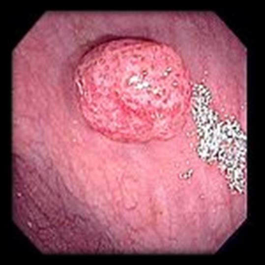Clinical Background Polyp Anything that protrudes above