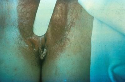 Primary Syphilis Chancre in a Syphilis Woman Source: