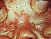 Gonorrhea Symptoms o Thick yellow discharge o Burning with urination o Rash if systemic