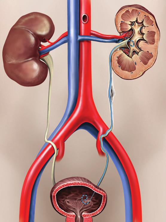 What will happen if I decide not to have a ureteric stent? Your kidney can become permanently damaged. The risk is higher if your kidney is already infected.