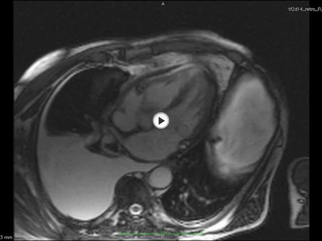 CMR with cine images can show early diastolic septal flattening or inversion in the majority of constrictive pericarditis patients : Four-chamber cine