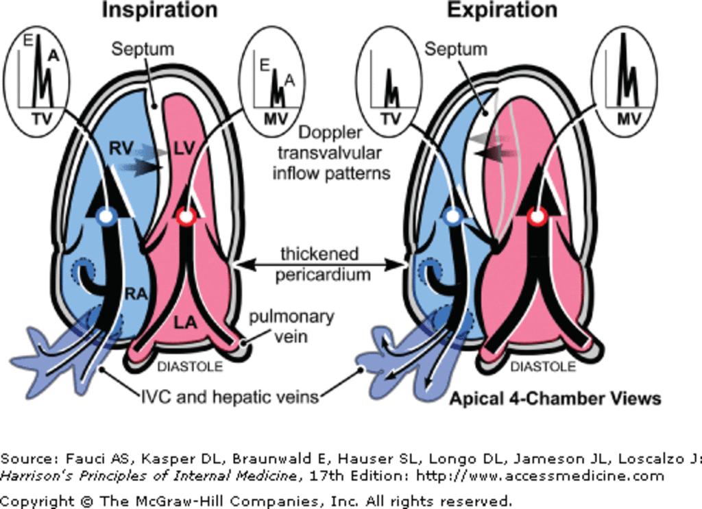 : Constrictive pericarditis. Doppler schema of respirophasic changes in mitral and tricuspid inflow.